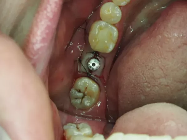 za-8-implant-w-jamie-ustnej